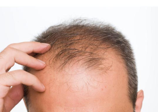La Masturbaciòn Causa Perdida De Cabello